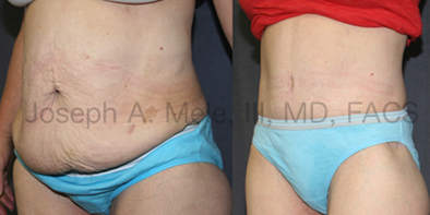 Complicaciones y dolor después de una abdominoplastia - Spanish Hourglass  Tummy Tuck