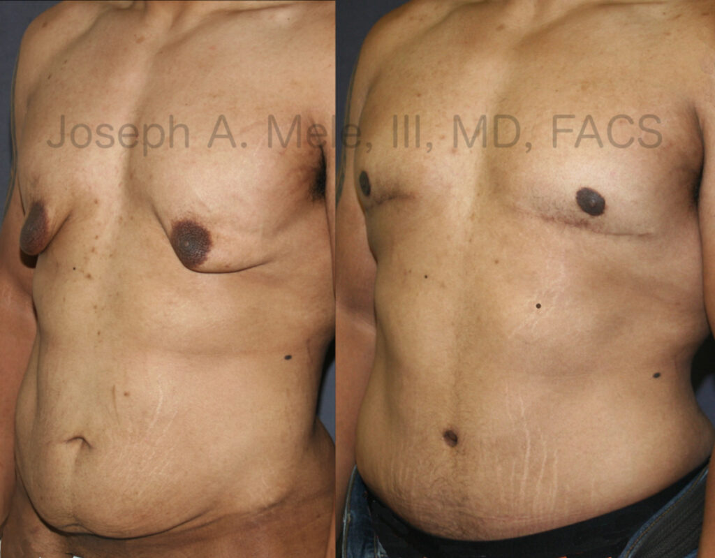 Cirugía Plástica Post Cirugía Bariátrica San Francisco Walnut Creek CA, image size:1024x799